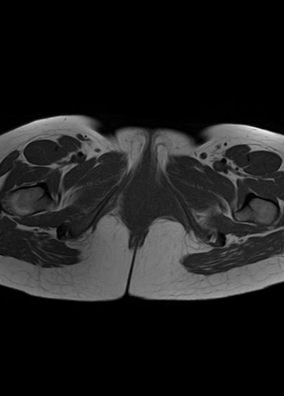 File:Aggressive angiomyxoma of the pelvis and perineum (Radiopaedia 59162-66479 T1 3).jpg