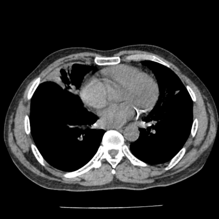 Airway foreign body in adult (Radiopaedia 85907-101779 Axial liver window 116).jpg