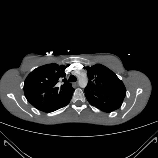 File:Alagille syndrome with pulmonary hypertension (Radiopaedia 49384-54980 A 3).jpg
