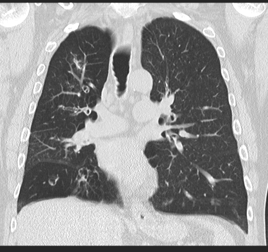 Allergic bronchopulmonary aspergillosis (Radiopaedia 44760-48571 Coronal lung window 30).png