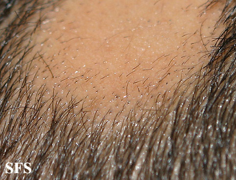 Alopecia Areata (Dermatology Atlas 50).jpg