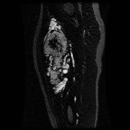 Alveolar soft part sarcoma (Radiopaedia 64501-73678 D 70).jpg