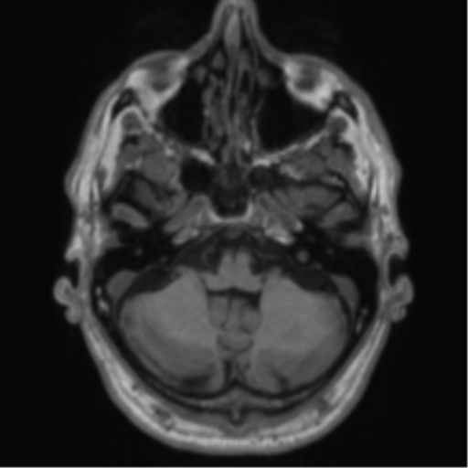 Alzheimer's disease- with Gerstmann syndrome and dressing apraxia (Radiopaedia 54882-61150 Axial T1 15).png