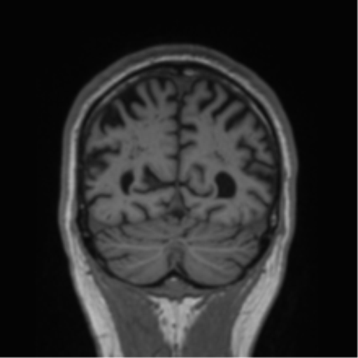 File:Alzheimer's disease- with Gerstmann syndrome and dressing apraxia (Radiopaedia 54882-61150 Coronal T1 20).png