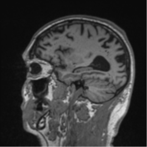 Alzheimer's disease- with Gerstmann syndrome and dressing apraxia (Radiopaedia 54882-61150 Sagittal T1 51).png
