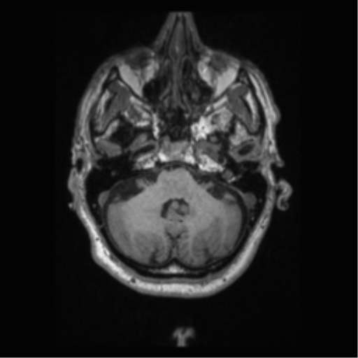 Alzheimer disease - probable (Radiopaedia 35334-36837 Axial T1 20).png