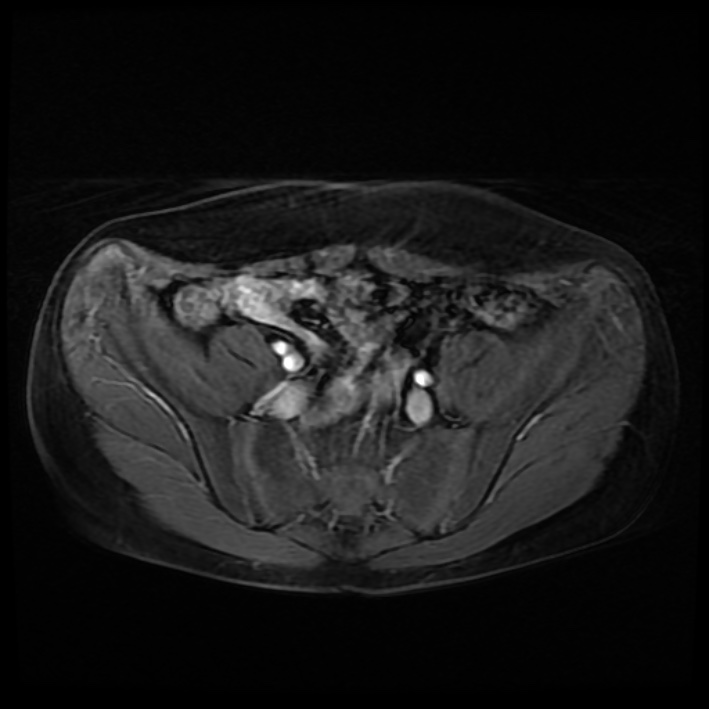 Ambiguous genitalia (Radiopaedia 69686-79643 Axial T1 C+ fat sat 8).jpg