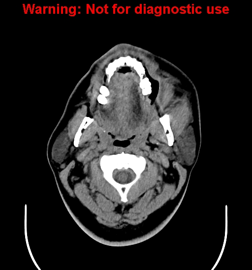 File:Ameloblastoma (Radiopaedia 33126-34164 A 4).jpg