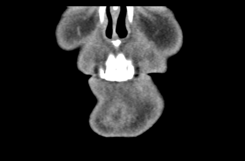 Ameloblastoma (Radiopaedia 33677-34806 Coronal non-contrast 12).png