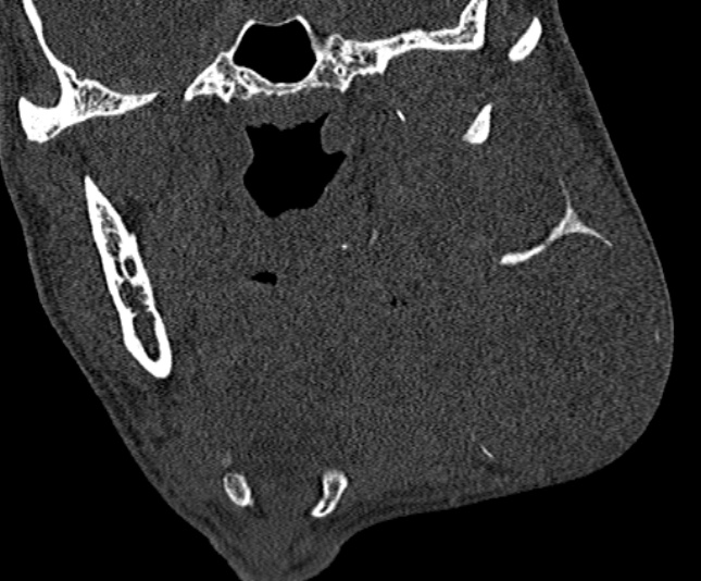 Ameloblastoma (Radiopaedia 51921-57766 Coronal bone window 149).jpg