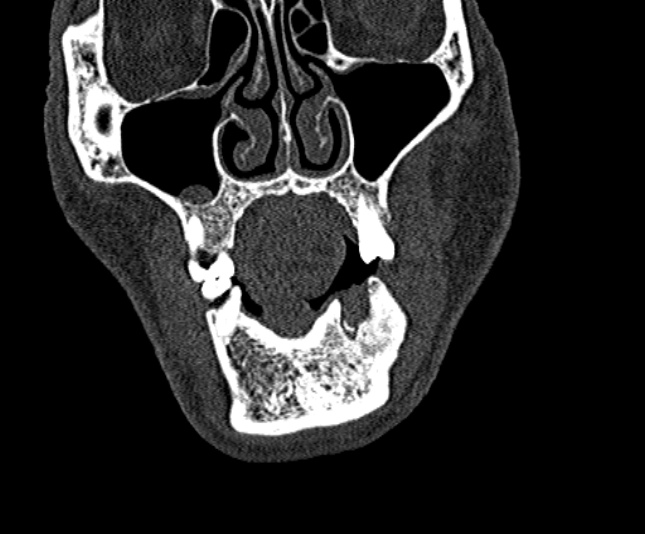 Ameloblastoma (Radiopaedia 51921-57766 Coronal bone window 51).jpg