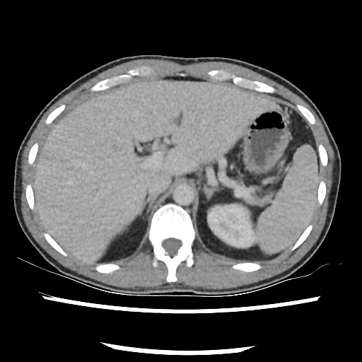Amoebic liver abscesses (Radiopaedia 55536-62010 A 26).jpg