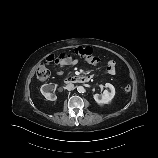 Ampullary adenocarcinoma (Radiopaedia 59373-66734 C 70).jpg