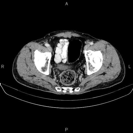 Ampullary adenocarcinoma (Radiopaedia 86093-102032 A 51).jpg