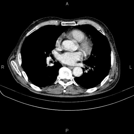 Ampullary adenocarcinoma (Radiopaedia 86093-102033 B 36).jpg