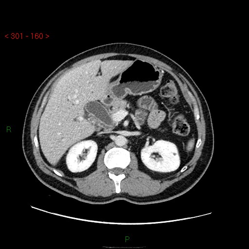 File:Ampullary carcinoma (Radiopaedia 56396-63056 C 34).jpg
