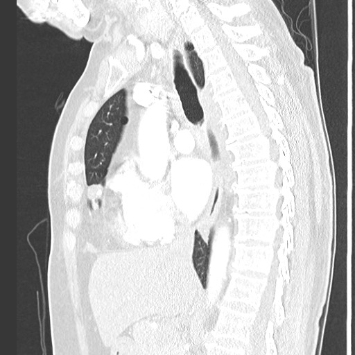 Amyloidosis - bronchial and diffuse nodular pulmonary involvement (Radiopaedia 60156-67745 Sagittal lung window 44).jpg