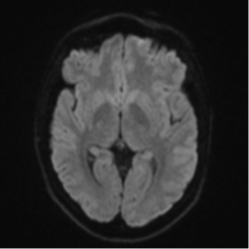 File:Anaplastic astrocytoma (Radiopaedia 57768-64731 Axial DWI 41).png