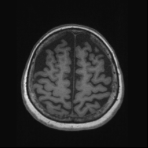 Anaplastic astrocytoma IDH wild-type (pseudoprogression) (Radiopaedia 42209-45276 Axial T1 118).png