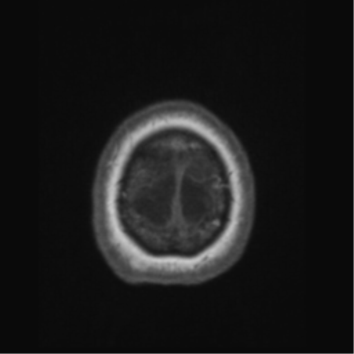 Anaplastic astrocytoma IDH wild-type (pseudoprogression) (Radiopaedia 42209-45276 Axial T1 143).png