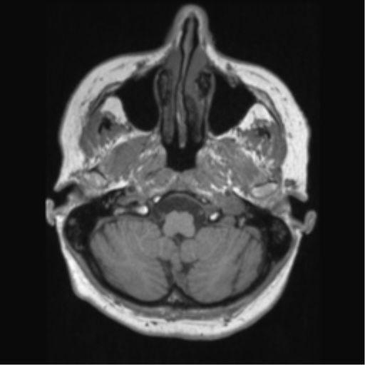 File:Anaplastic astrocytoma IDH wild-type (pseudoprogression) (Radiopaedia 42209-45276 Axial T1 30).png
