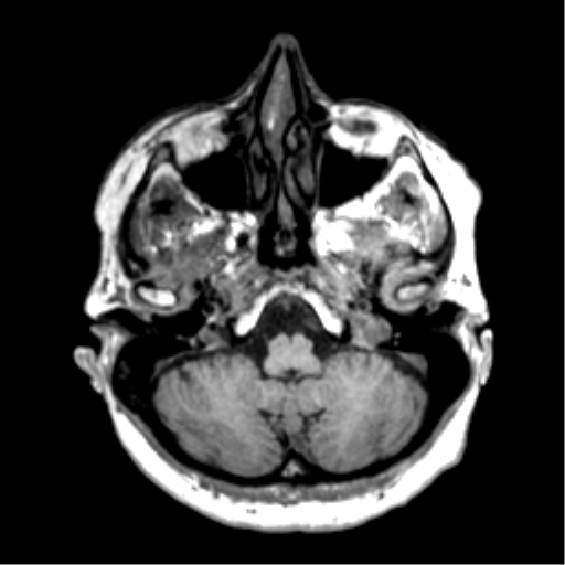 Anaplastic astrocytoma IDH wild-type (pseudoprogression) (Radiopaedia 42209-45277 Axial T1 23).png
