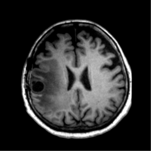 Anaplastic astrocytoma IDH wild-type (pseudoprogression) (Radiopaedia 42209-45277 Axial T1 86).png