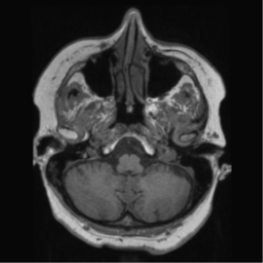 File:Anaplastic astrocytoma IDH wild-type (pseudoprogression) (Radiopaedia 42209-45278 Axial T1 38).png
