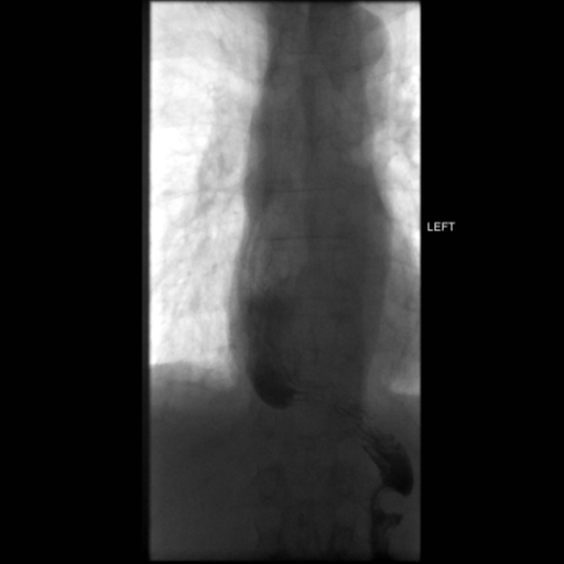 File:Anastomotic stricture post Ivor Lewis esophagectomy (Radiopaedia 47937-52715 C 15).png