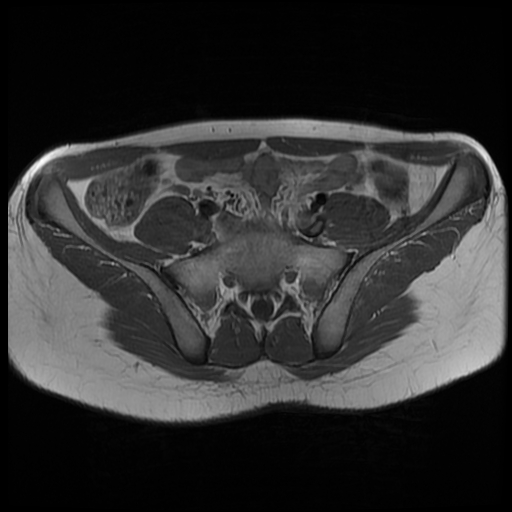 File:Androgen insensitivity syndrome (Radiopaedia 38585-40727 Axial T1 2).jpg