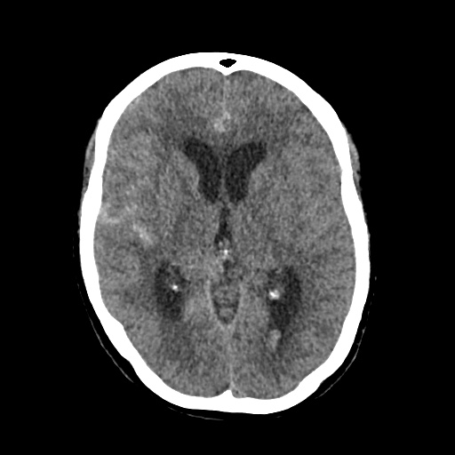 File:Aneursym related subarachnoid hemorrhage with hydrocephalus (Radiopaedia 45105-49083 Axial non-contrast 23).jpg