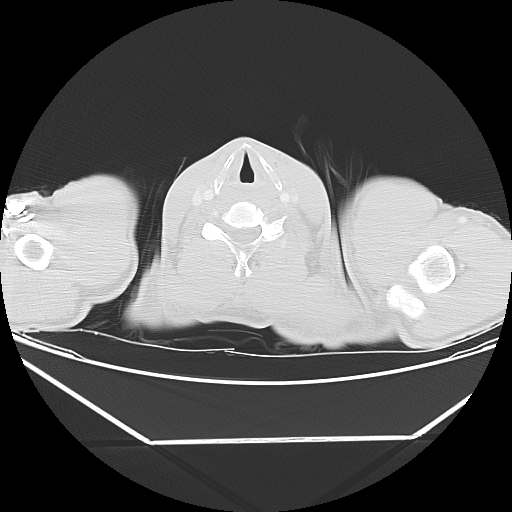Aneurysmal bone cyst - rib (Radiopaedia 82167-96220 Axial lung window 1).jpg