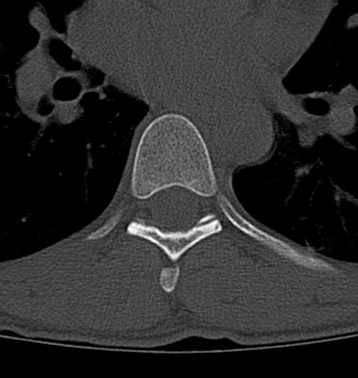 File:Aneurysmal bone cyst T11 (Radiopaedia 29294-29721 Axial bone window 7).jpg