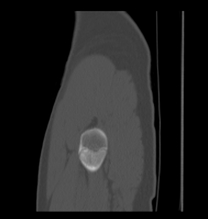 File:Aneurysmal bone cyst of ischium (Radiopaedia 25957-26094 Sagittal bone window 5).png