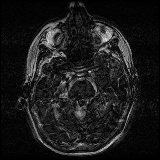 Angioinvasive aspergillosis in the pituitary fossa (Radiopaedia 39676-42010 Ax 3D FIESTA VOLUME 35).png