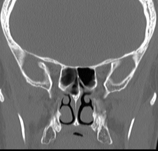 Angular epidermoid cyst (Radiopaedia 46908-51439 Coronal bone window 39).png