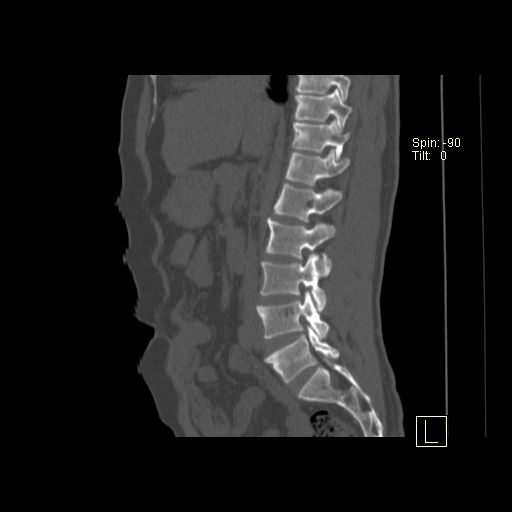 File:Ankylosing spondylitis (Radiopaedia 52728-58645 Sagittal bone window 14).jpg
