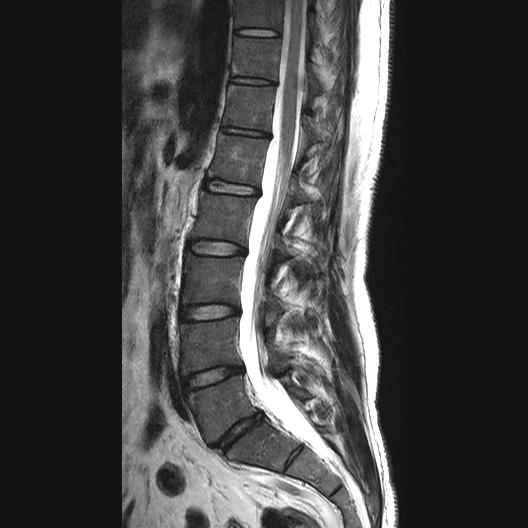 File:Ankylosing spondylitis with zygapophyseal arthritis (Radiopaedia 38433-40516 Sagittal T2 6).jpg