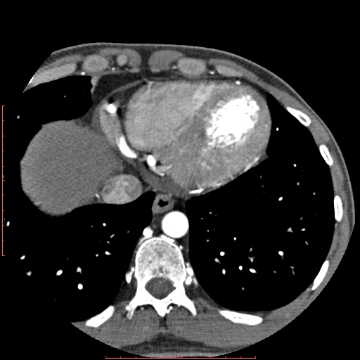 File:Anomalous left coronary artery from the pulmonary artery (ALCAPA) (Radiopaedia 70148-80181 A 318).jpg
