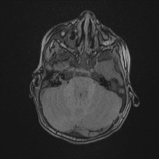 Anoxic brain injury (Radiopaedia 79165-92139 Axial MRA 57).jpg