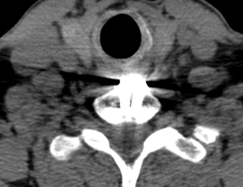 Anterior cervical postdiscectomy arthrodesis (Radiopaedia 32678-33646 Axial non-contrast 61).jpg