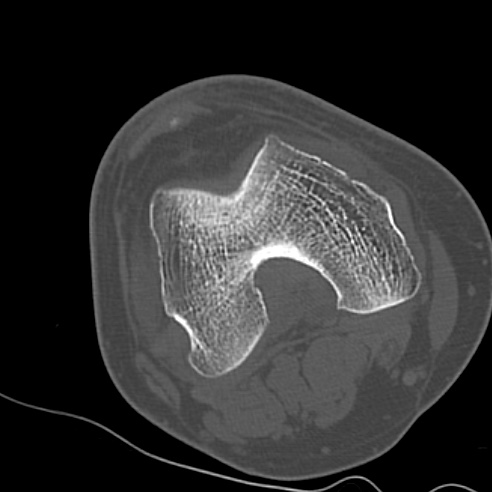 File:Anterior cruciate ligament avulsion fracture (Radiopaedia 58939-66194 Axial bone window 8).jpg