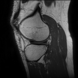 Anterior cruciate ligament rupture and posteromedial corner injury (Radiopaedia 67338-76723 Sagittal PD 126).jpg