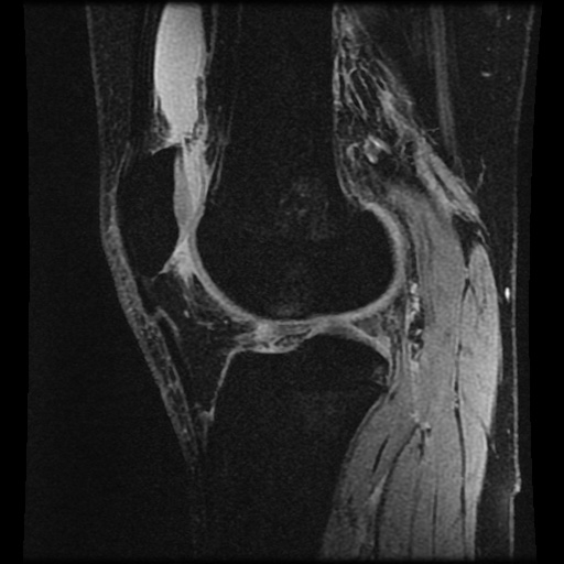 Anterior cruciate ligament tear (Radiopaedia 61500-69462 F 56).jpg
