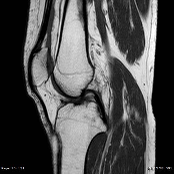 File:Anterior cruciate ligament tear (Radiopaedia 70783-80964 Sagittal T1 15).jpg