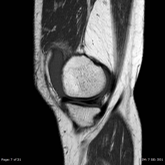 File:Anterior cruciate ligament tear (Radiopaedia 70783-80964 Sagittal T1 7).jpg