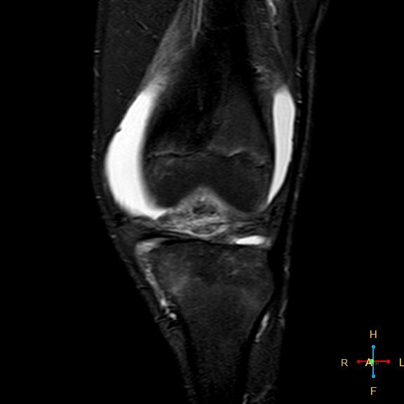 File:Anterior cruciate ligament tear - complete (Radiopaedia 24907-25170 Coronal STIR 6).jpg