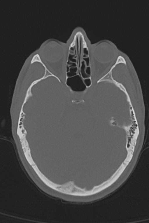 Anterior nasal spine fracture (Radiopaedia 46138-50494 Axial bone window 39).png