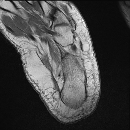 File:Anterior talofibular ligament injury - rupture with soft-tissue impingement (Radiopaedia 38765-40928 Axial PD 33).jpg