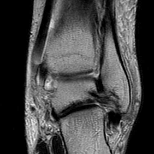 File:Anterior talofibular ligament rupture (Radiopaedia 15831-15484 Coronal T2 15).jpg